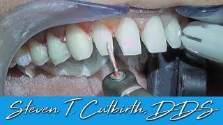 Prepping Teeth for Veneers InDepth Instructions  Dental Minute with Steven T Cutbirth DDS [upl. by Duhl]