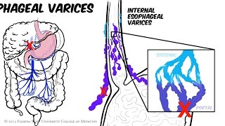 Portal Hypertension Animated Review [upl. by Chadd]