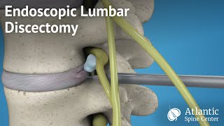 Endoscopic Lumbar Discectomy [upl. by Audrit]